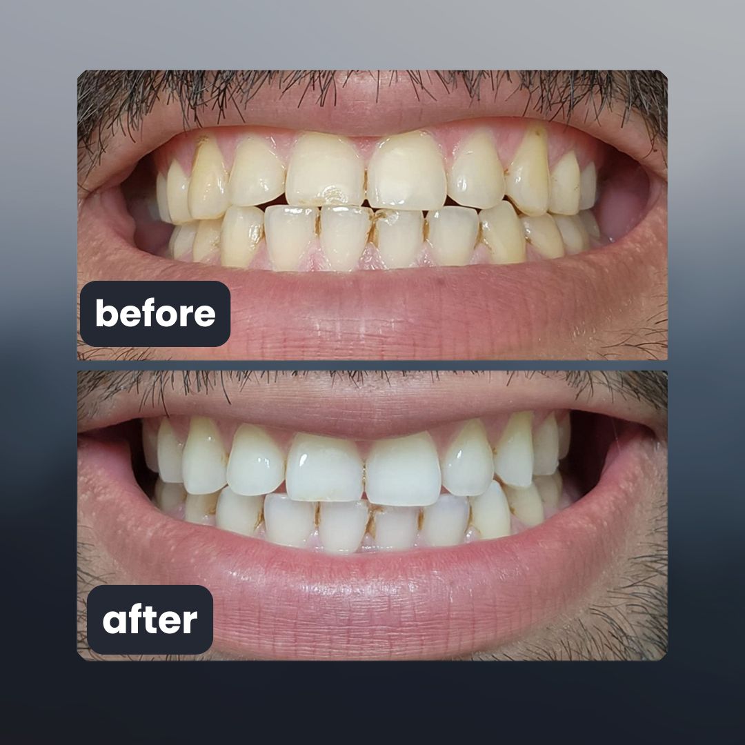 sovelora - purple teeth whitening strips