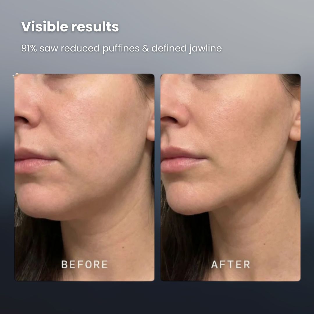 Sculpra - 4-in-1 Facial sculpting & lymphatic device